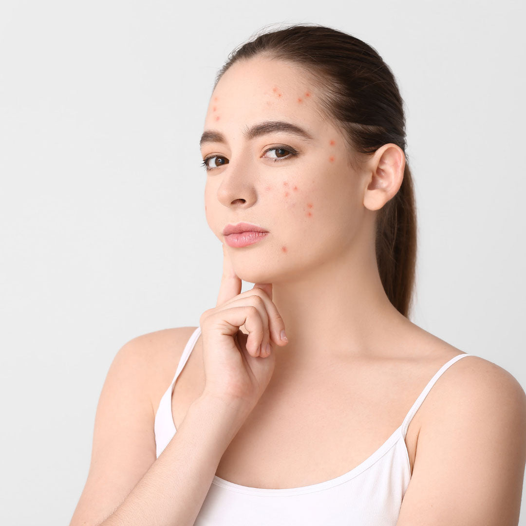 Red light therapy for acne